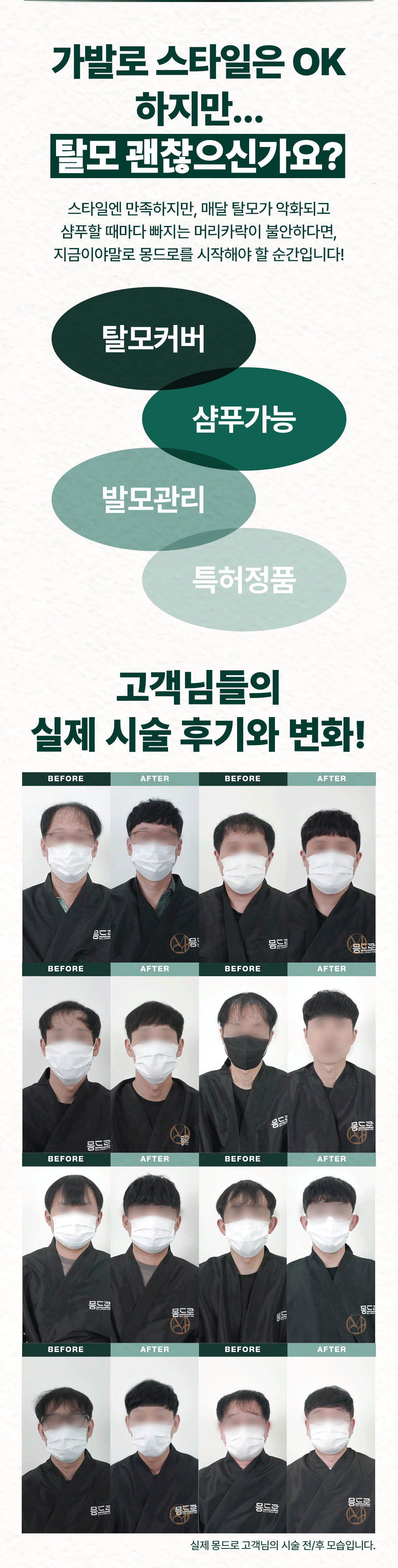 남성 탈모 시술 관련 이미지 4